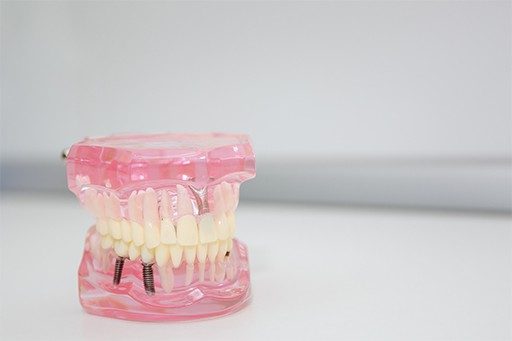 implant-dentar