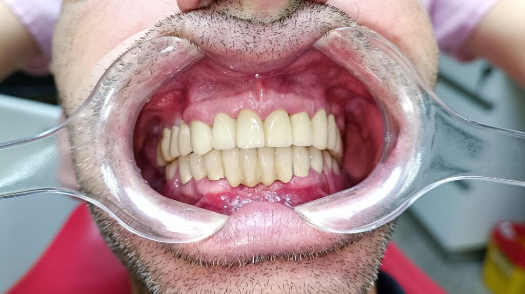 implant-dentar