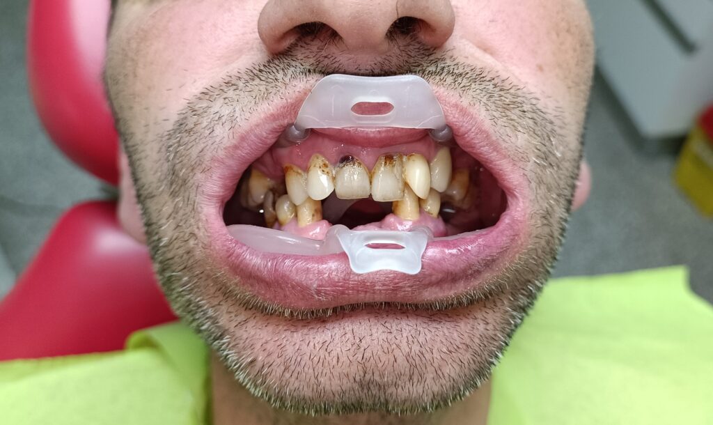 implanturi-dentare
